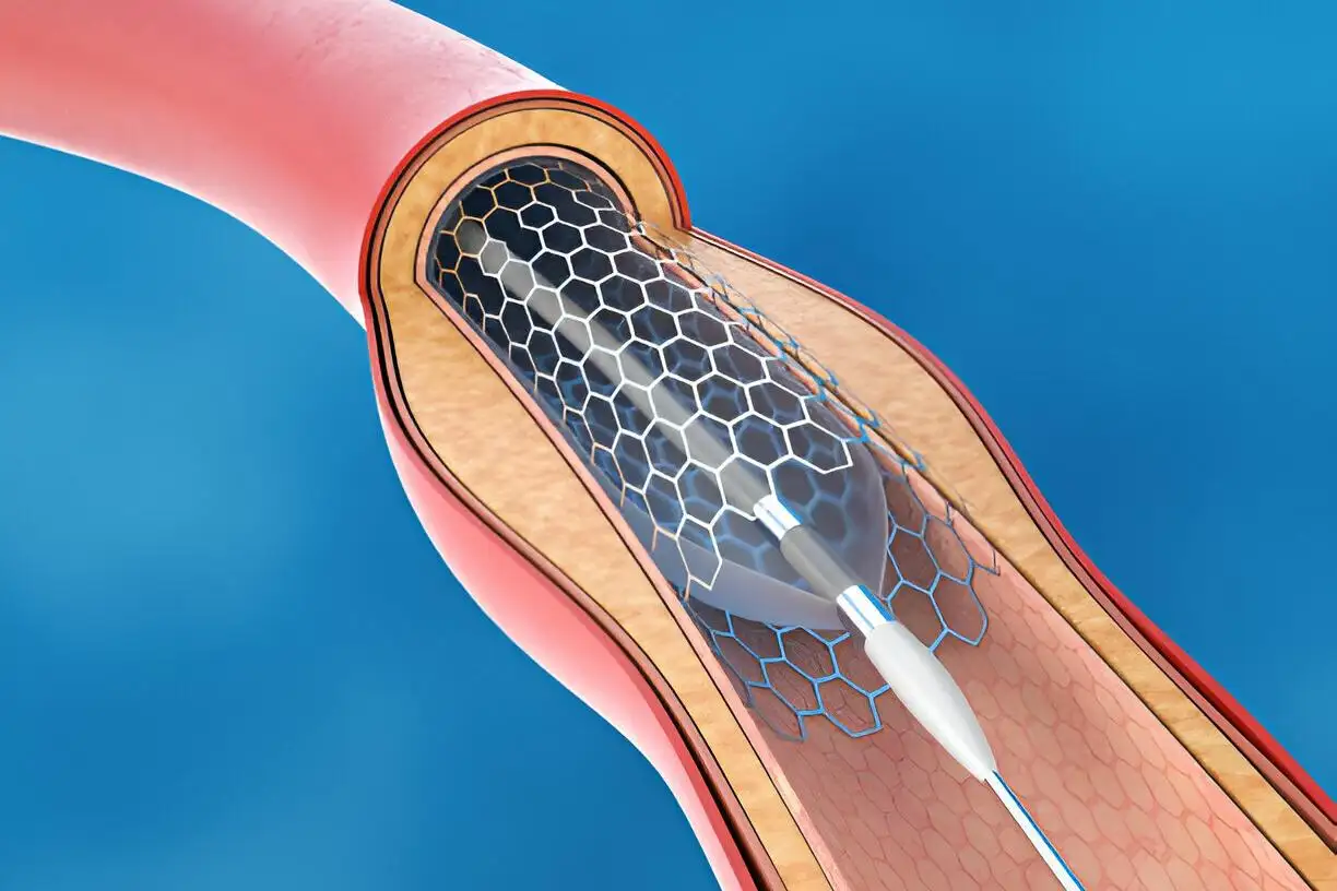 medical-Stent Implantation for Blood Circulation